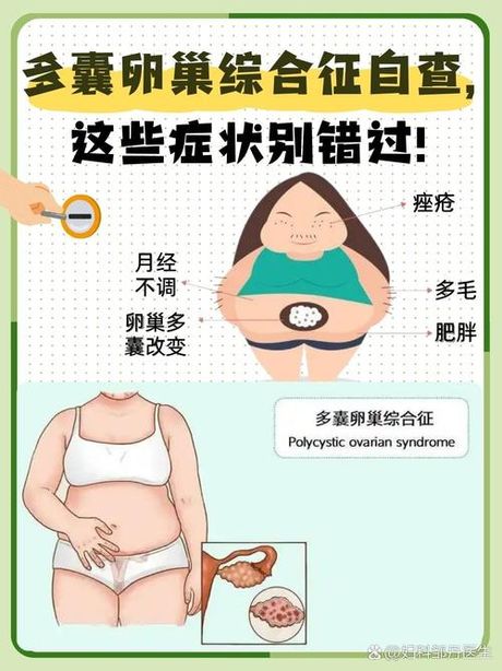 多囊性卵巢综合症：女性健康的潜在威胁